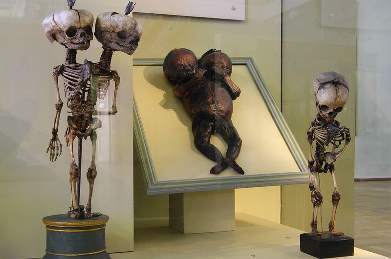 The Skeleton Of Conjoined Twins