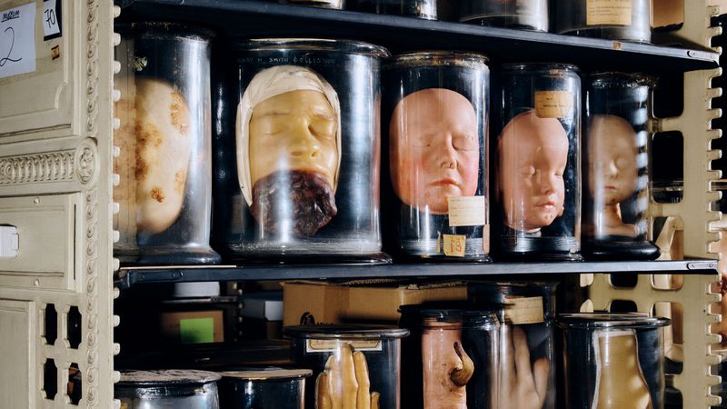 Facial Casts Of Famous Medical Cases