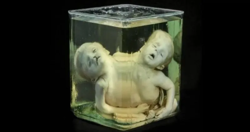 Conjoined Twins Preserved In Formaldehyde
