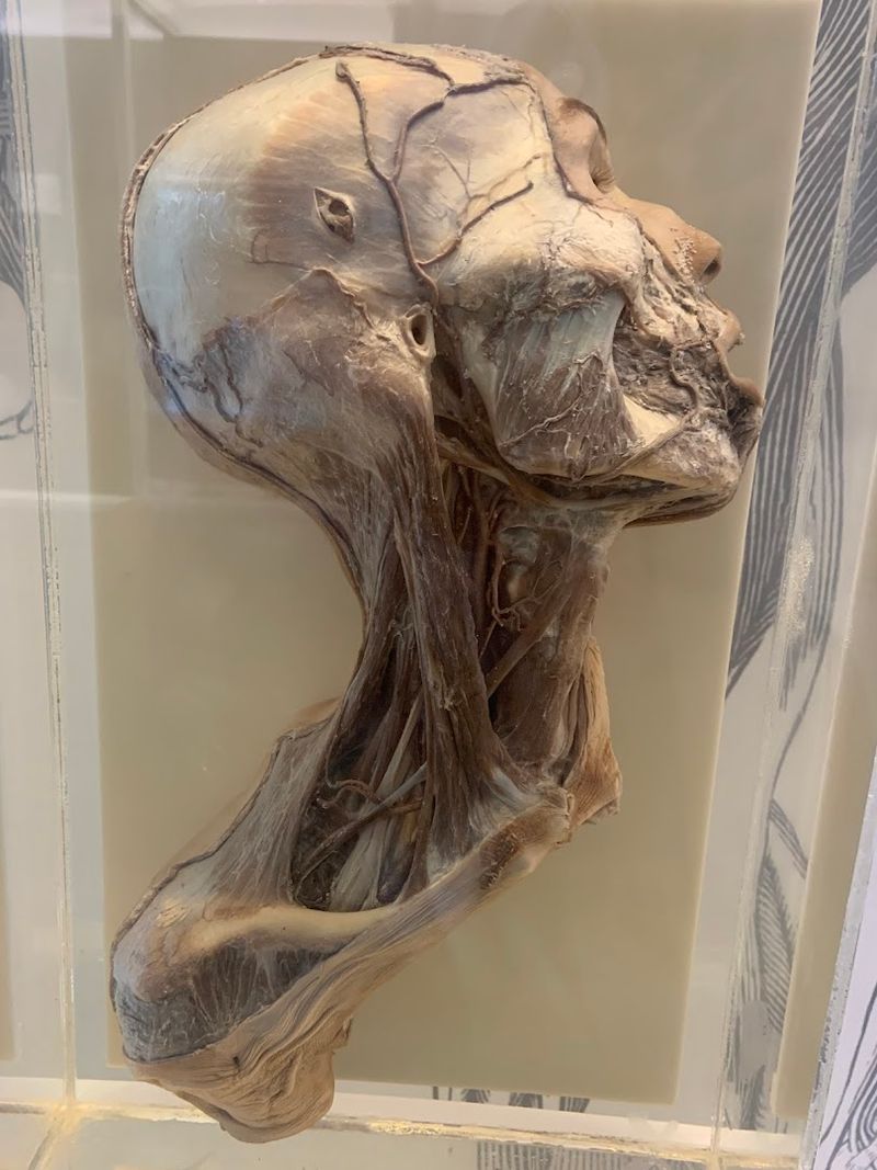 The Human Hairball Specimen
